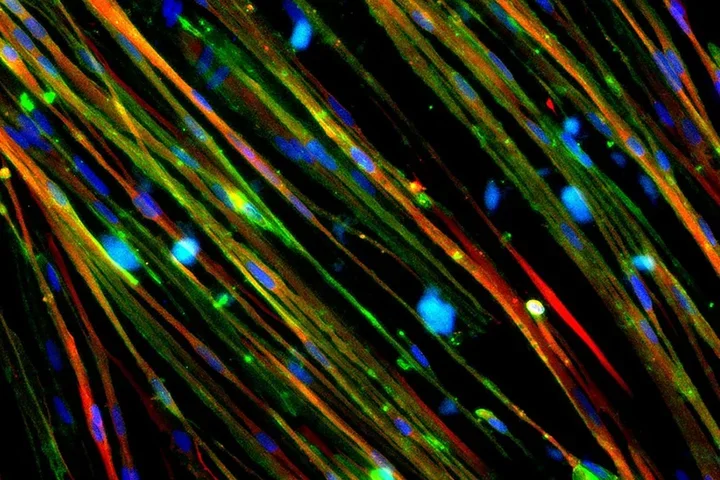 The restoration of dystrophin (stained green) in Duchenne muscle cells is shown above.